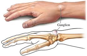 Wrist Ganglion