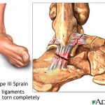 Type-III-ankle-sprain